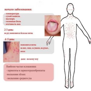 Вспышка кори на Одесчине: число заболевших детей приблизилось к 80