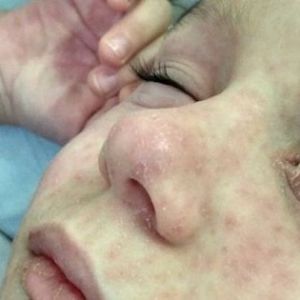 Одесская область: в Бессарабии продолжается вспышка кори